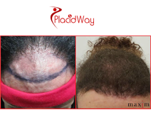 Slider image (3) MAXIM Hair Restoration Philippines